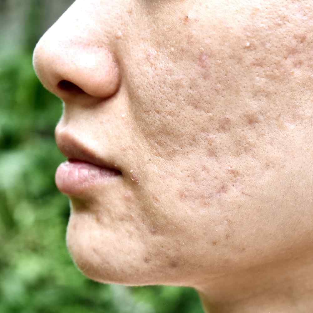 Scar Free Skin Does Accutane Get Rid Of Acne Scars 