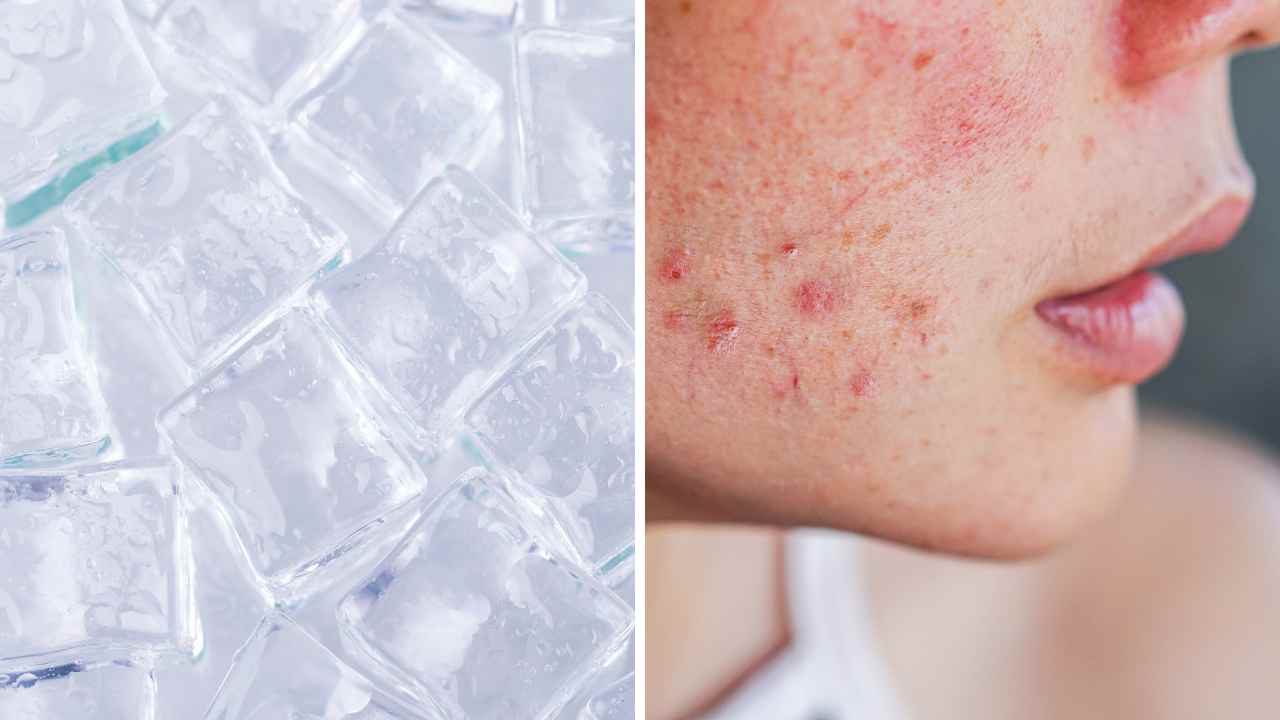 brrr-ing-on-the-benefits-does-ice-help-acne-breakouts