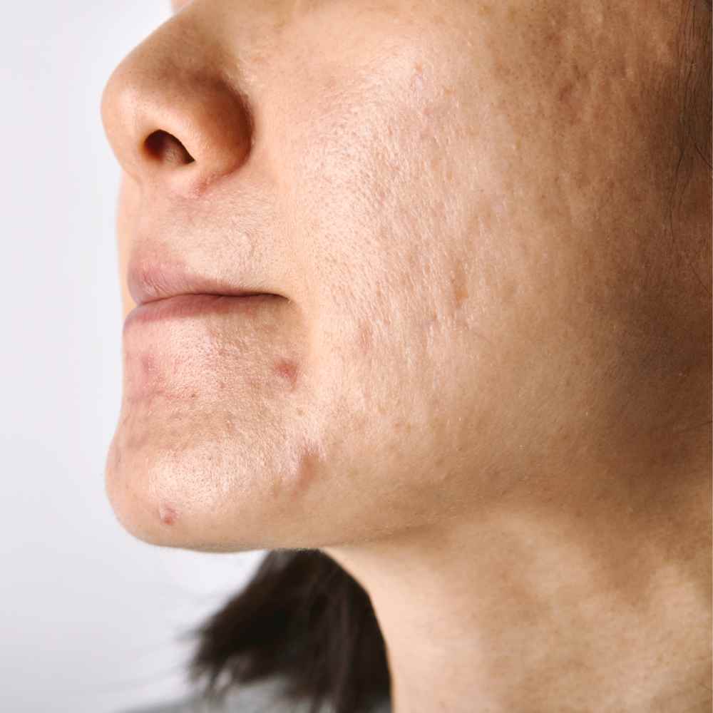 Does Tretinoin Help With Acne Scars Benefits Risks 