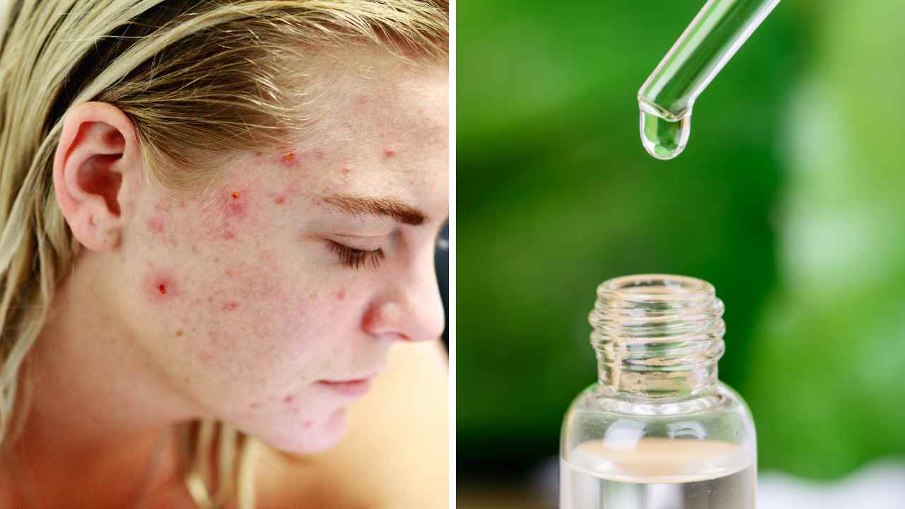 does-niacinamide-help-with-acne-the-science-behind-it