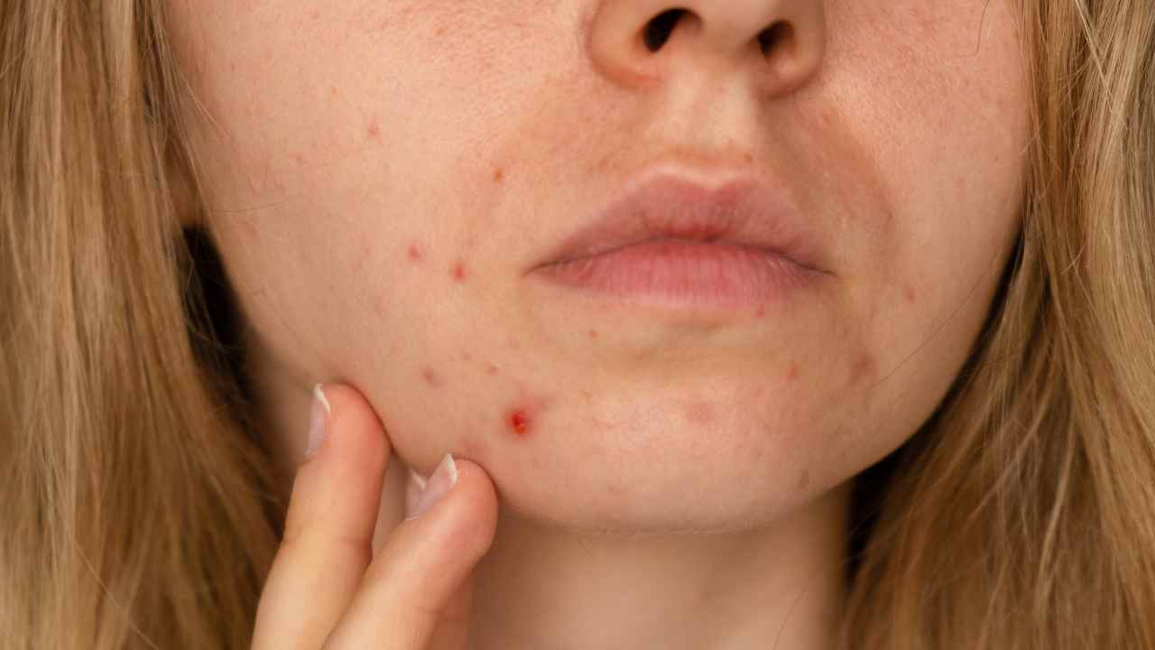 bumps-on-your-face-is-acne-a-sign-of-pregnancy