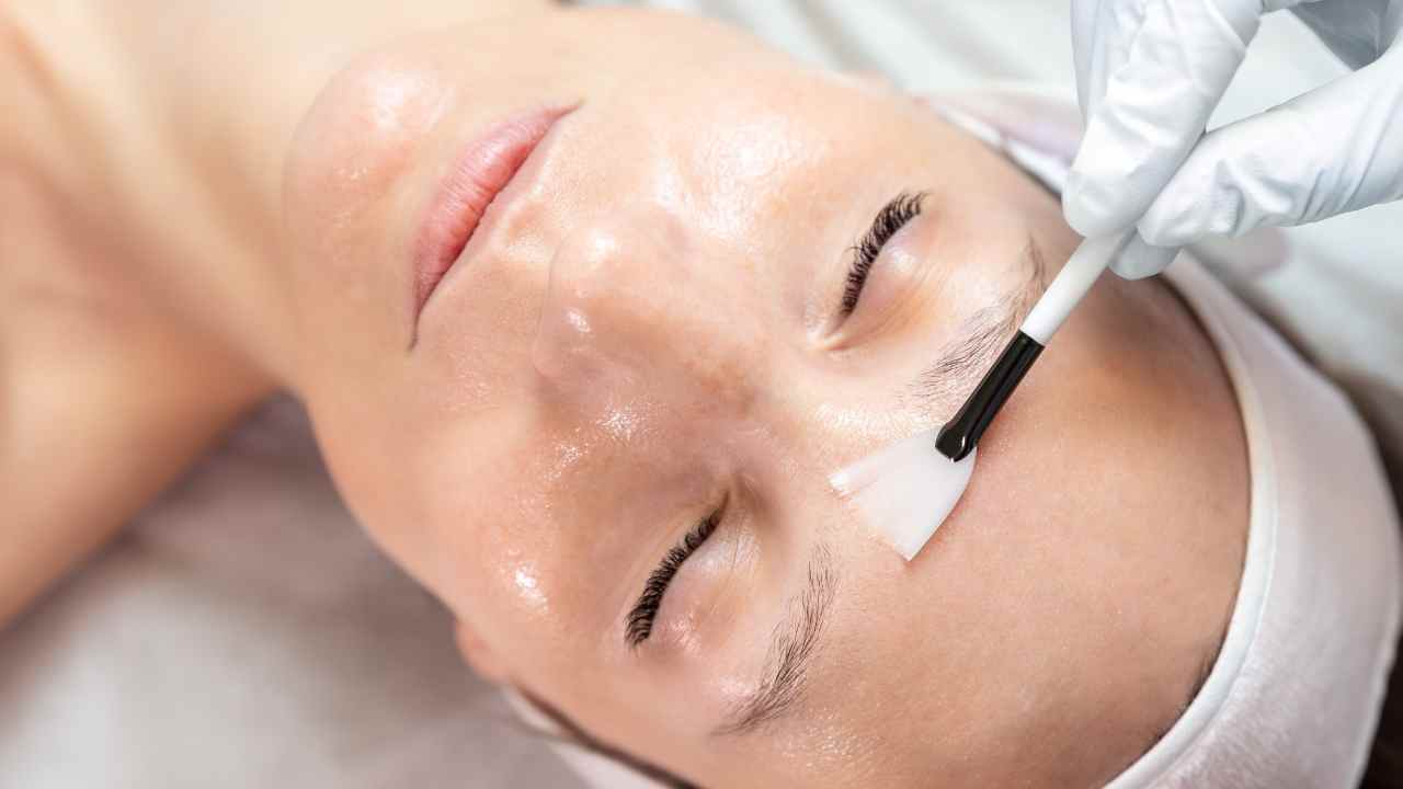 peel-pimples-how-to-treat-breakouts-post-chemical-peel