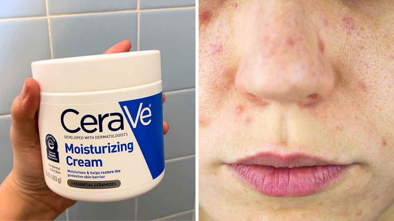 Does Cerave Moisturizing Cream Cause Acne The Truth 