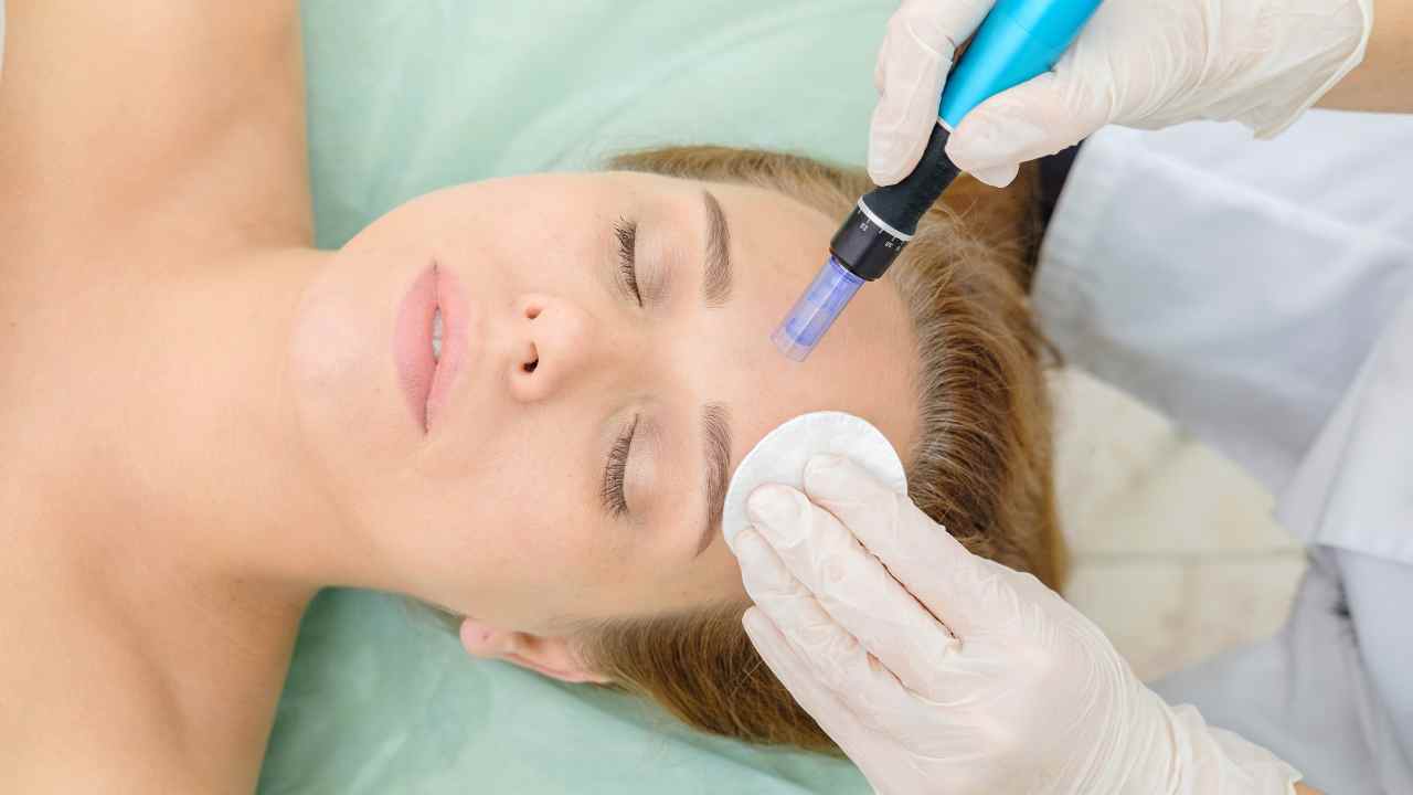 how-to-treat-breakouts-after-microneedling-appointments