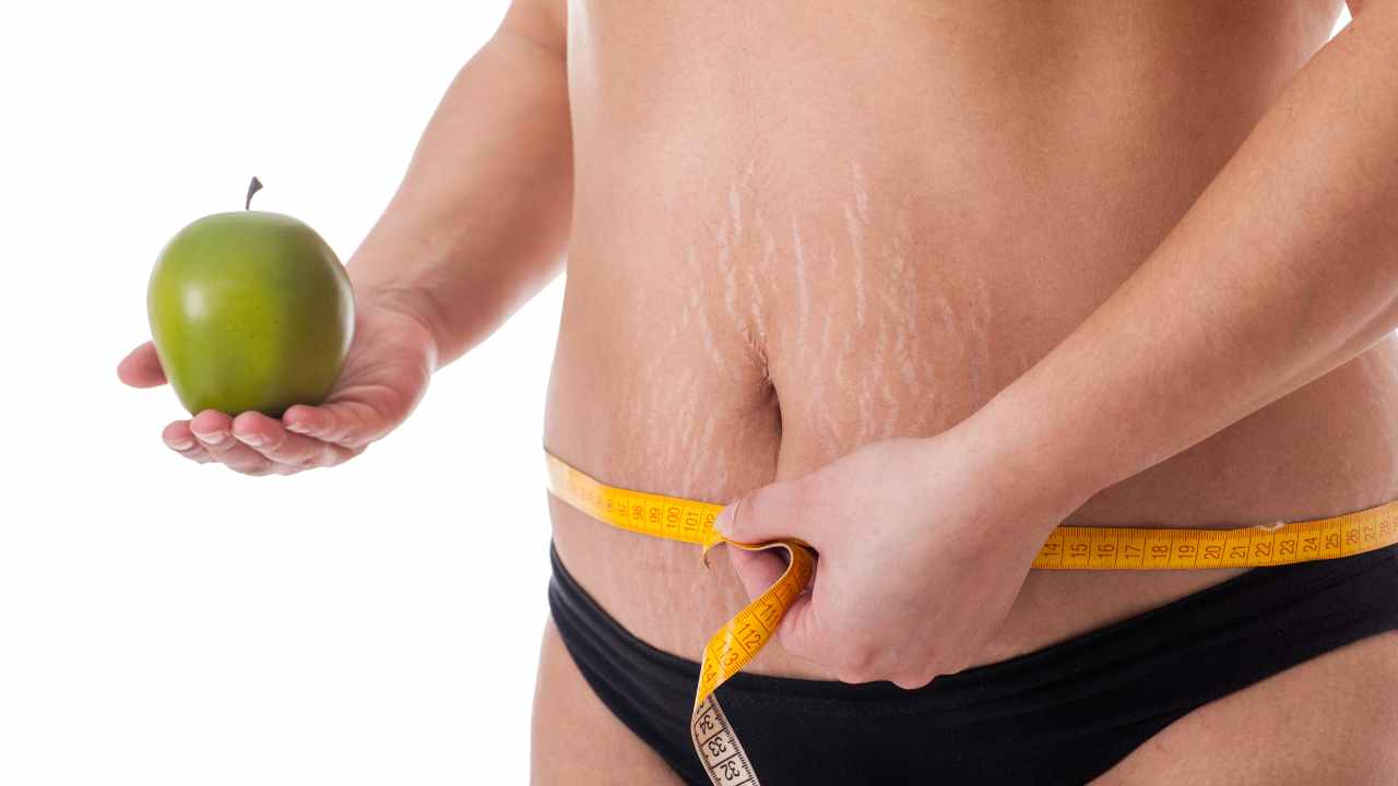 how-to-handle-stretch-marks-after-weight-loss