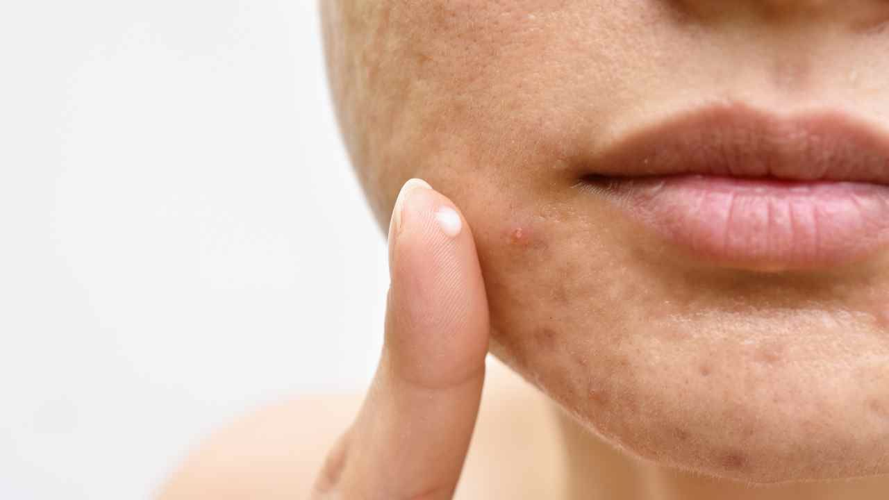 Can Triamcinolone Acetonide be Used for Acne or Not?