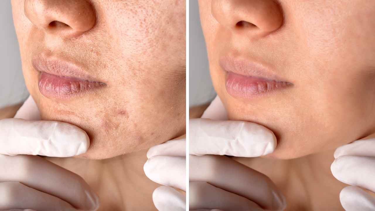 Does Tretinoin Help With Acne Scars Benefits Risks 