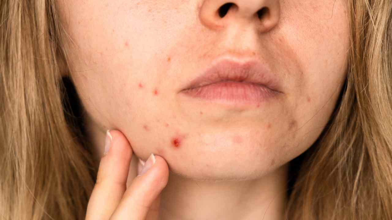 skincare-sos-how-to-tell-if-acne-is-hormonal-or-bacterial