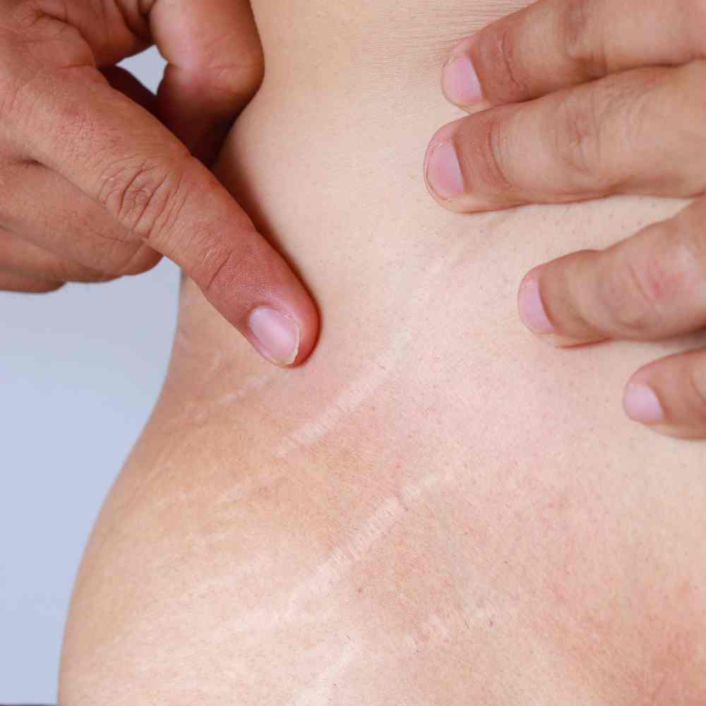 how-to-handle-stretch-marks-after-weight-loss