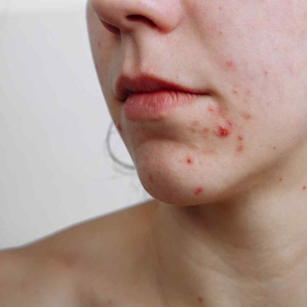 scar-free-skin-does-accutane-get-rid-of-acne-scars