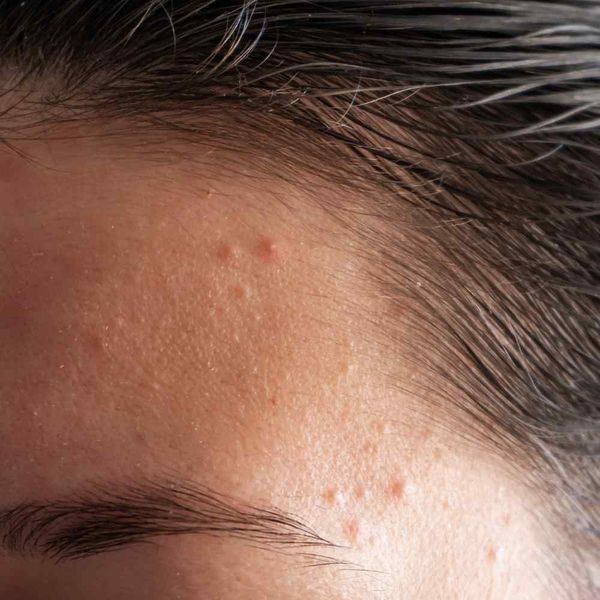 From Cleansers to Diet: How to Get Rid of Forehead Acne!